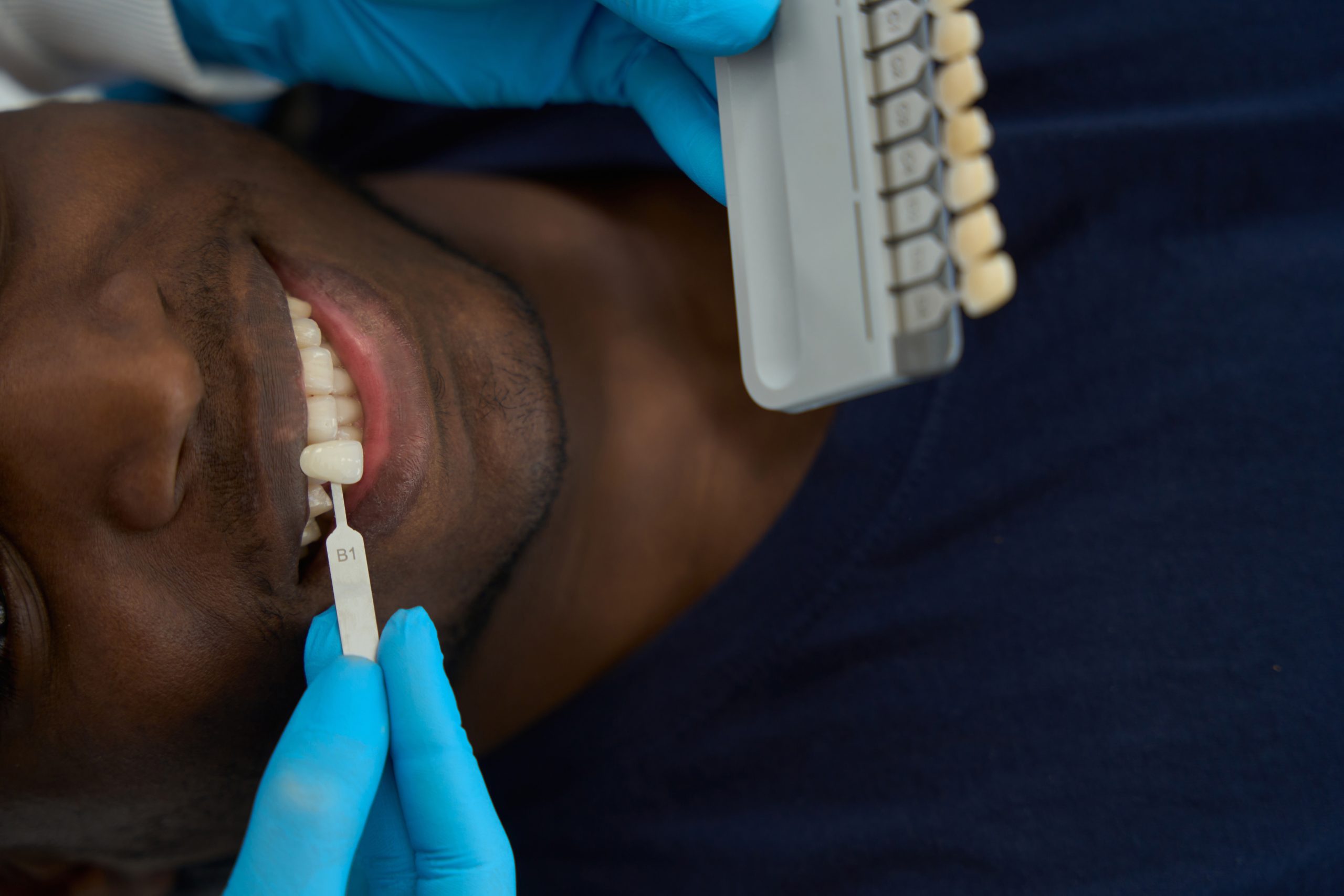 Transform Your Smile: The Top Benefits Of Veneers